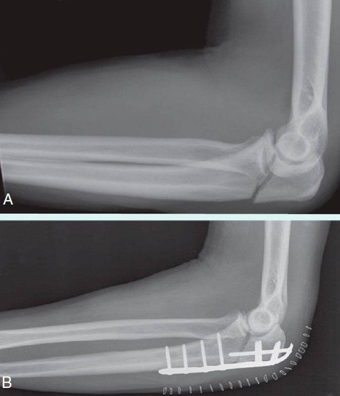 Radiograph, lateral view, showing fracture of the ulna at the elbow joint (A) and repair of this fracture (B) using internal fixation with a plate and multiple screws.