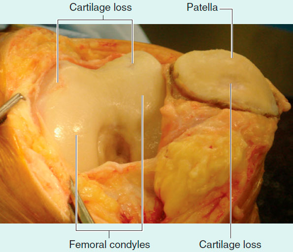The focal areas of cartilage loss in the patella and femoral condyles throughout the knee joint