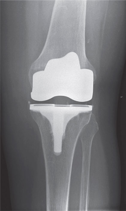 After knee replacement. This radiograph shows the position of the prosthesis