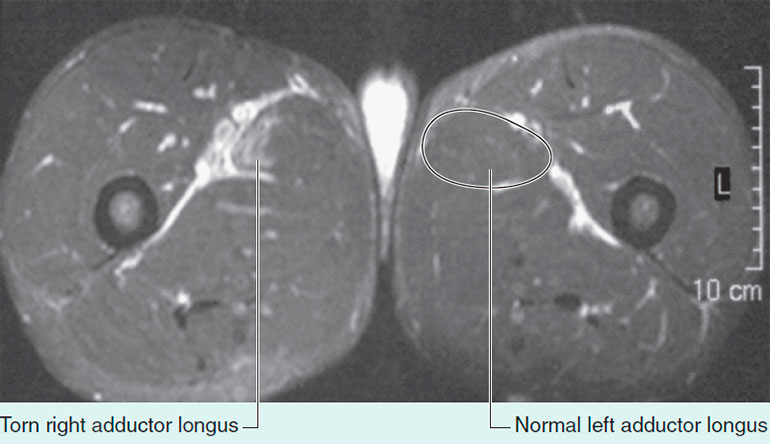 A muscle tear in the right adductor longus with edema in and around the muscle