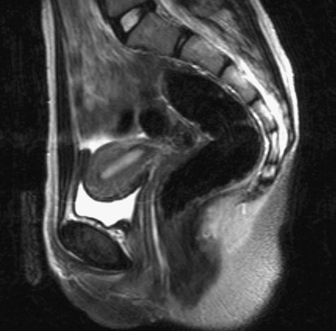 A T2-weighted MR image in the sagittal plane of the pelvic viscera in a woman