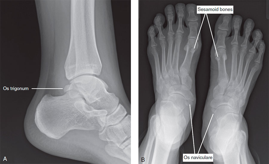 Accessory and sesamoid bones