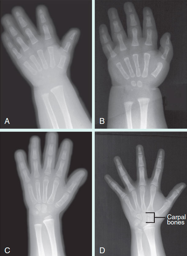 A developmental series of radiographs showing the progressive ossification of carpal (wrist) bones  