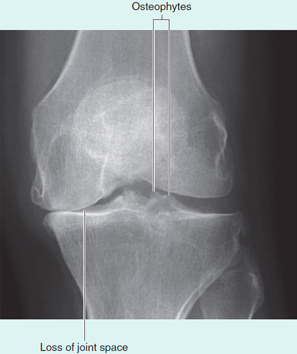 The loss of joint space in the medial compartment and presence of small spiky osteophytic regions at the medial lateral aspect of the joint