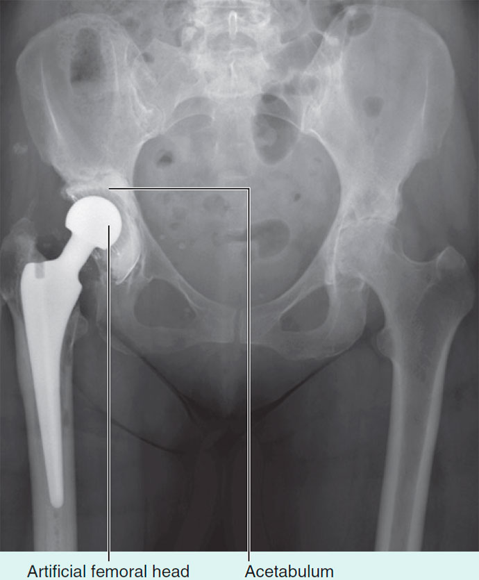 This is a radiograph, anteroposterior view, of the pelvis after a right total hip replacement. There are additional significant degenerative changes in the left hip joint, which will also need to be replaced