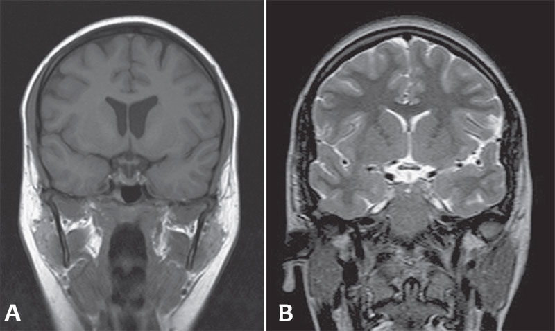 T1-weighted (A) and T2-weighted (B) MR images of the brain in the coronal plane