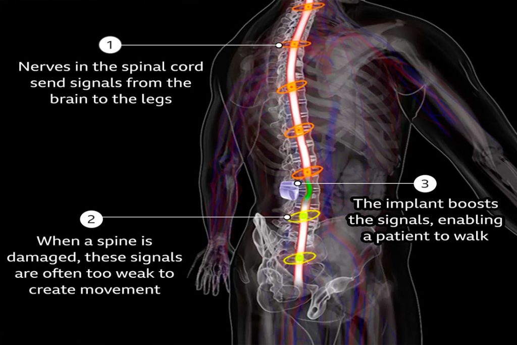 Spinal implant