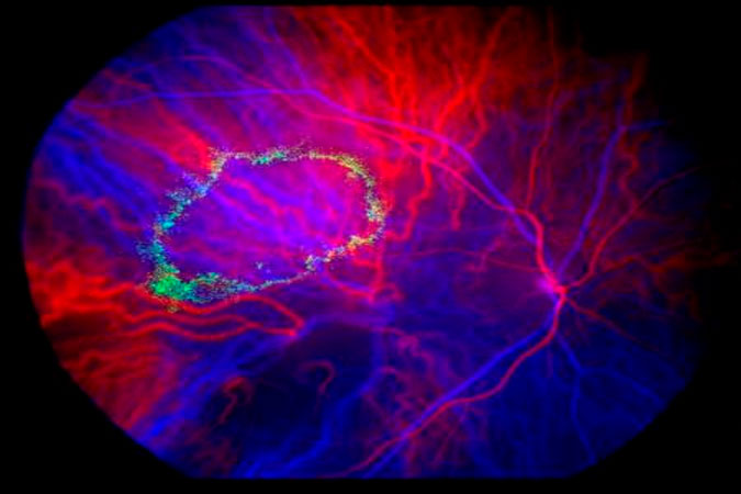 Unveiling the Dynamics of Blood Flow: Subtraction Angiography in Focus