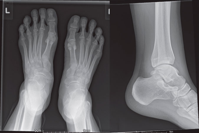 Accessory and Sesamoid Bones