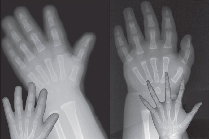 Skeletal Age Determination