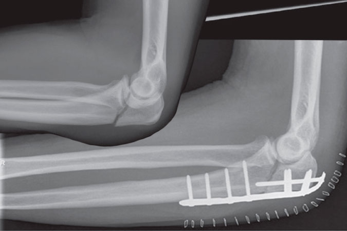 Fracture of the ulna at the elbow joint