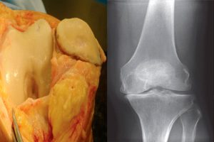 Degenerative Joint Disease (Osteoarthritis)