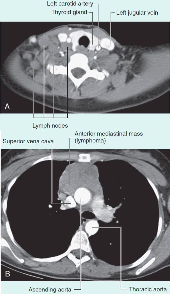 Lymphoma