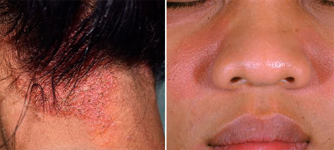 Seborrheic dermatitis