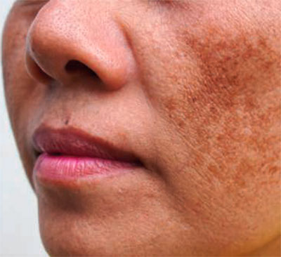 Melasma