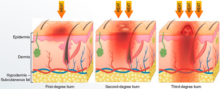 Degrees of burns