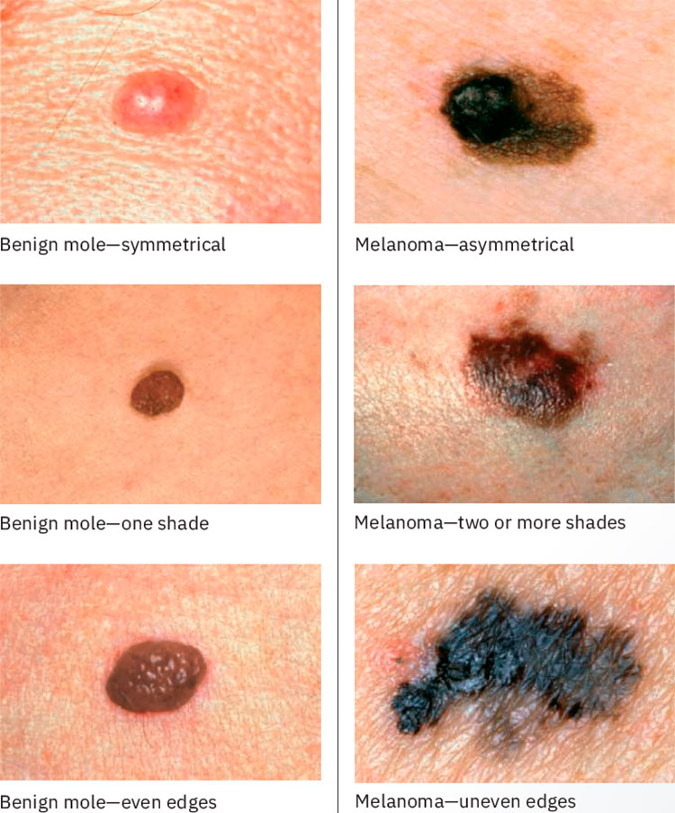 Benign moles compared to cancerous moles that show signs of asymmetry and changes to border, color, and diameter.