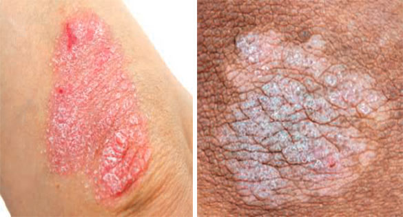 Psoriasis