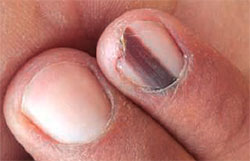 Nail melanoma