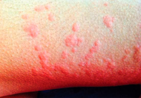 Irritant Contact Dermatitis