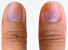 Discolored nail