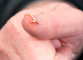 Plicatured nail