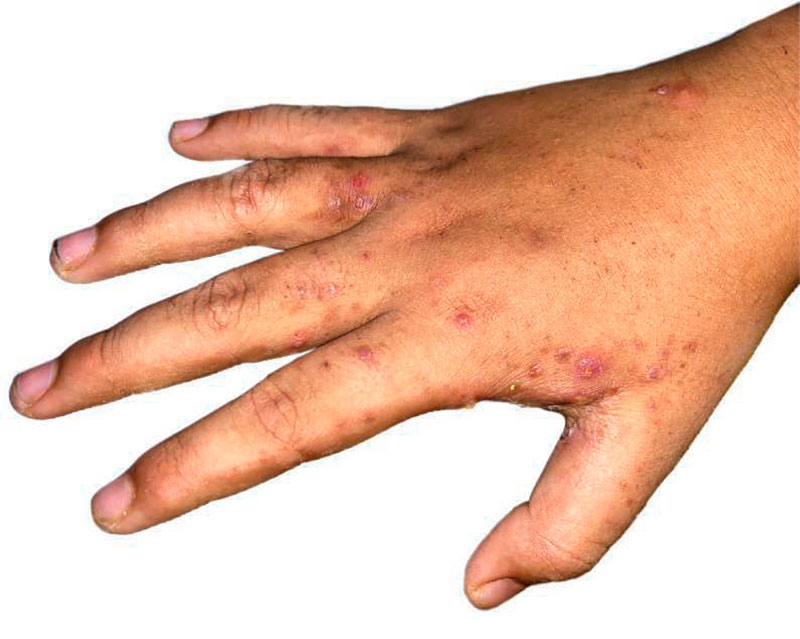 Scabies infestation