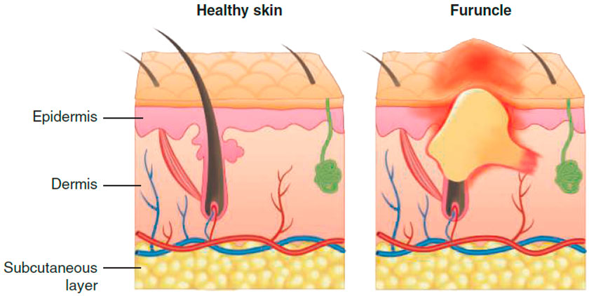 Cross-section of furuncle (boil)