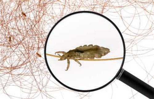 Head lice